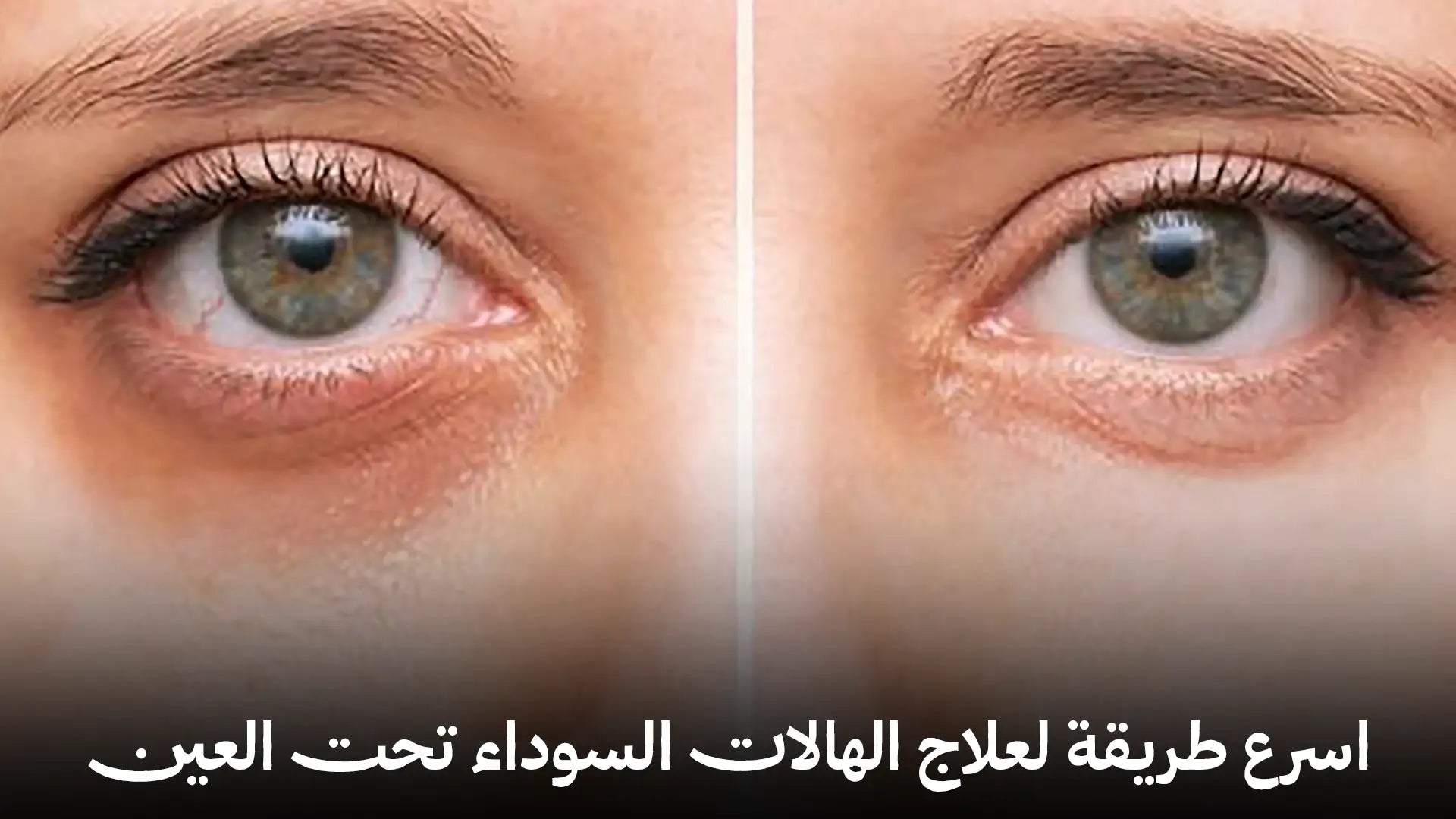 اسرع طريقه لعلاج الهالات السوداء تحت العين نهائيًا