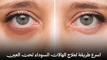 اسرع طريقه لعلاج الهالات السوداء تحت العين نهائيًا